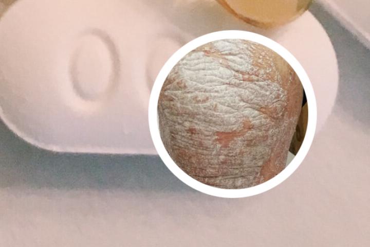 黄岛祖传根治牛皮癣