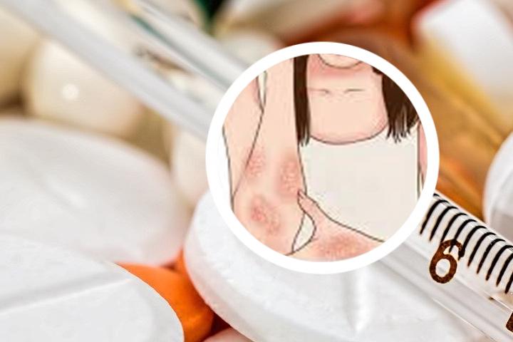 北京哪个医院治牛皮癣较好