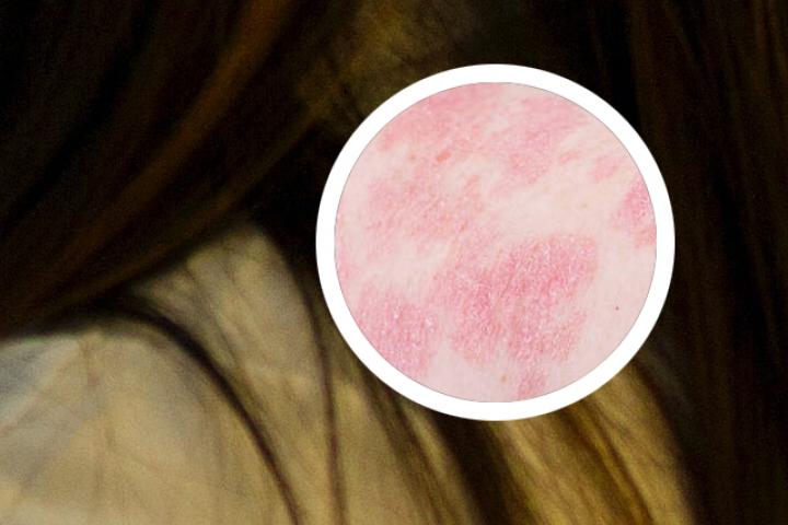 牛皮癣治疗前后对比案例
