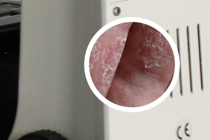 牛皮癣泡温泉外用卡泊三醇