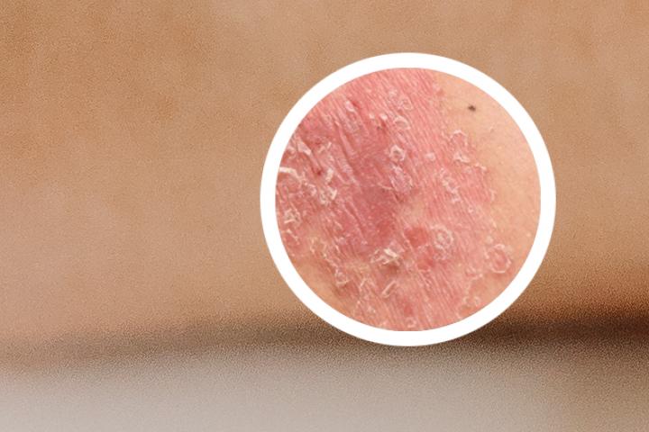 银屑病性传播吗