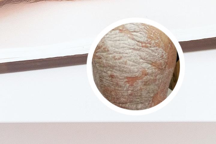 邳州哪家医院治牛皮癣好
