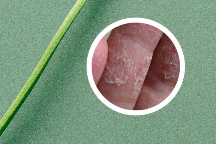 头孢会导致皮疹和银屑病吗