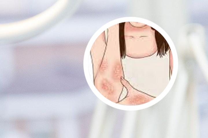 为什么牛皮癣一感冒就复发