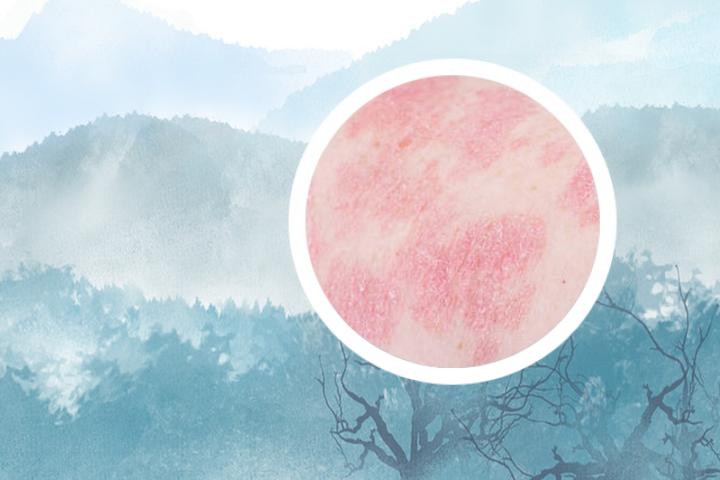 得了银屑病能