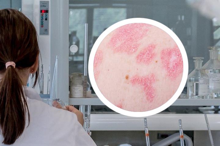 湿毒清药膏可以治疗银屑病吗