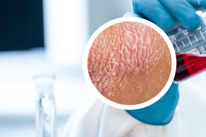 礼来生物制剂银屑病