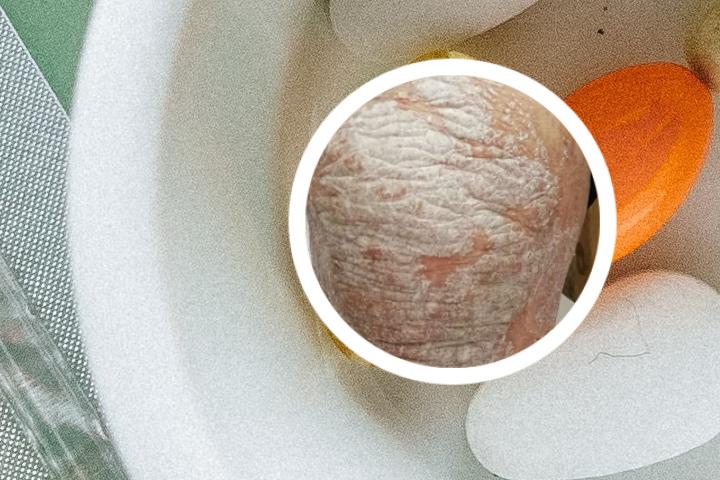 银屑病肛门湿疹