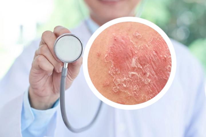 银屑病生物因子疗法