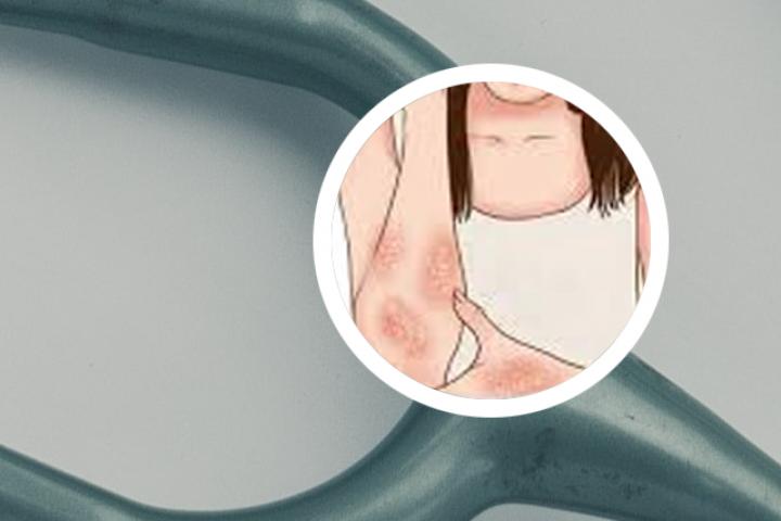 高度怀疑银屑病