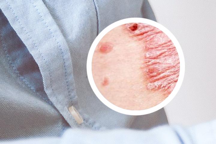 西宁哪里有银屑病生物制剂