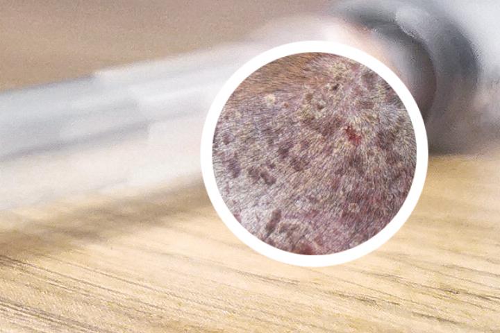 头皮型银屑病艾滋