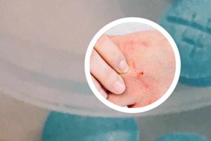 宝宝银屑病的表现