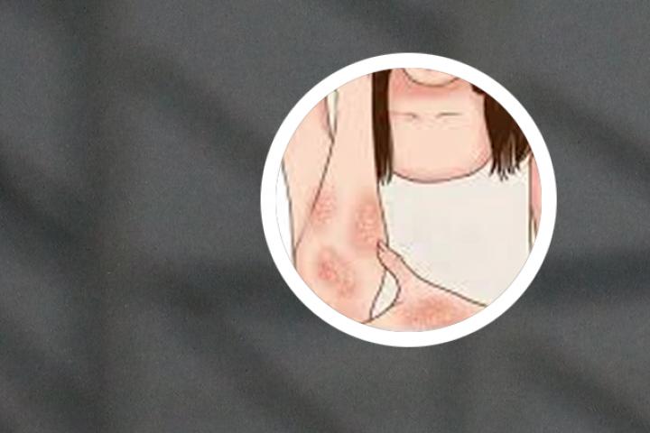 乌鲁木齐治银屑病
