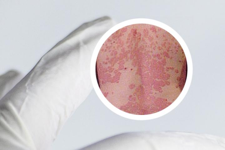 牛皮癣生物剂报销吗