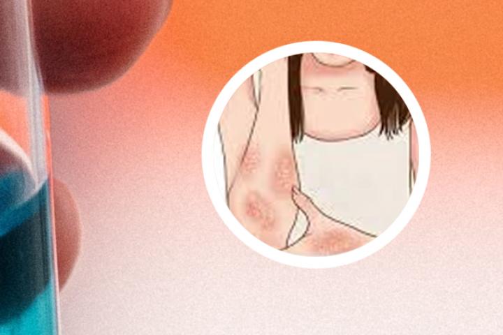 银屑病怀孕准备