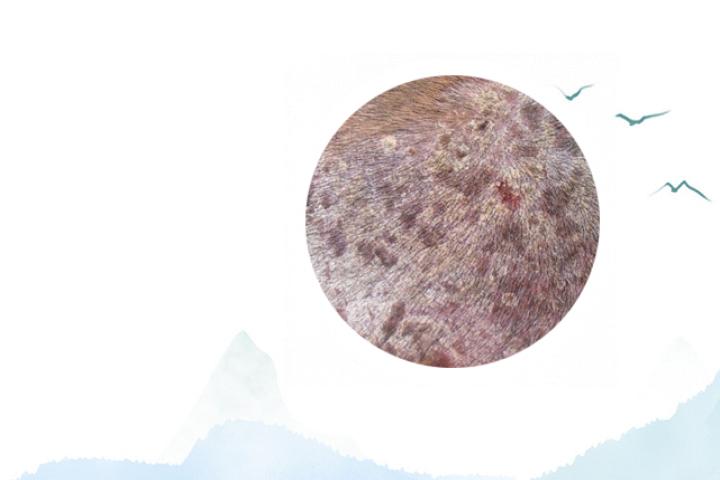 湿疹银屑病区分