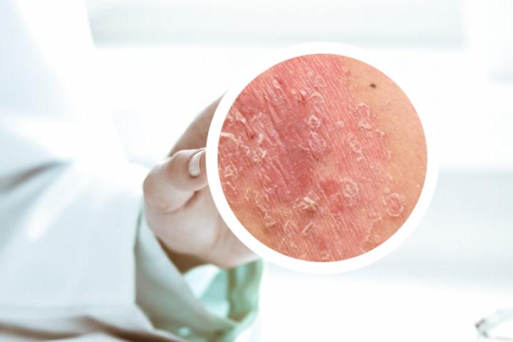 红豆薏米银屑病