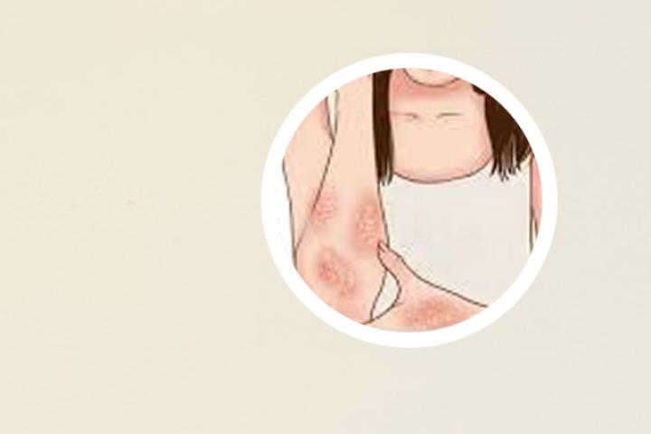银屑病可以吃大虾吗