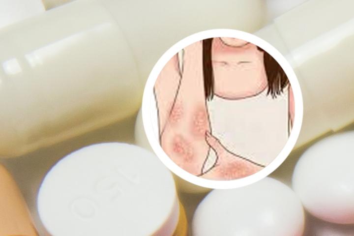 P21银屑病