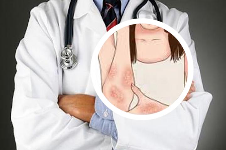 银屑病治疗平颜色紫黑