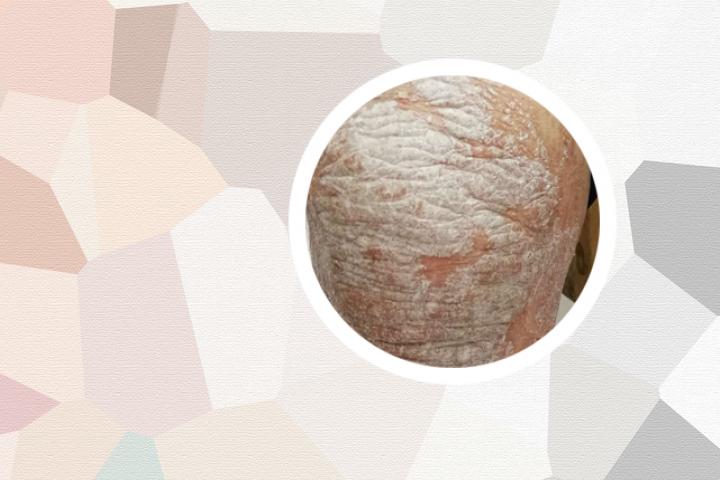 牛油可以治牛皮癣吗