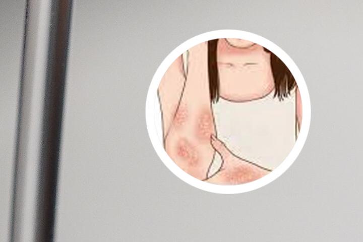 牛皮癣生宝宝没有病
