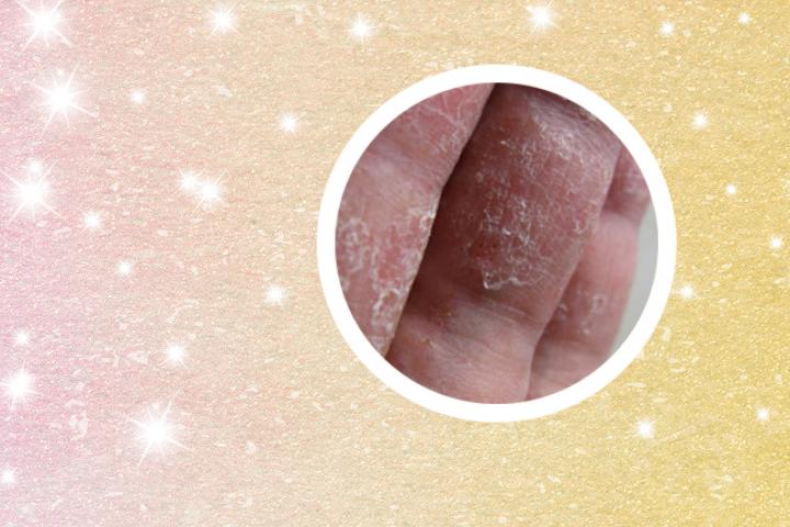 牛皮癣可以少量食用韭菜吗