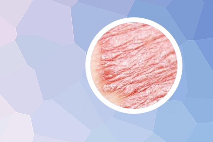 银屑病与太阳病有关吗
