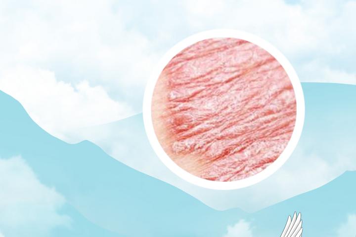 脓包型银屑病豆角能吃吗
