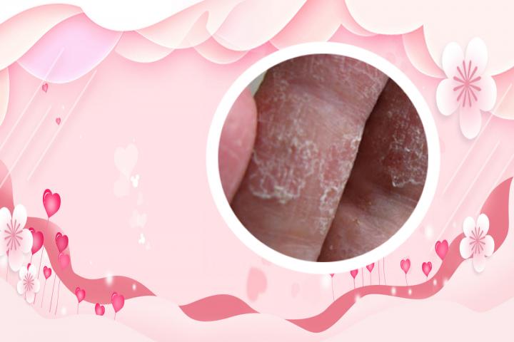 牛皮癣患者都能吃哪些水果