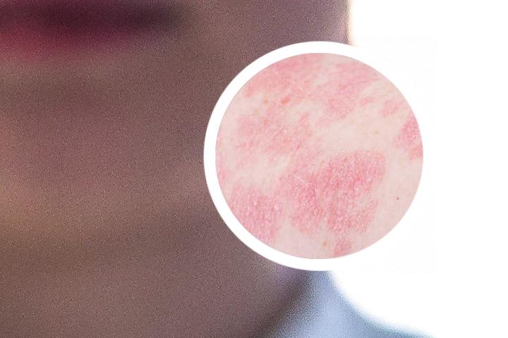 银屑病用外敷治愈例子