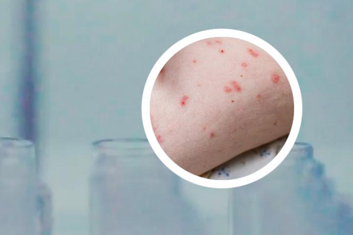 牛皮癣消退期注意什么