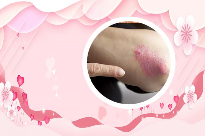 牛皮癣治疗方法有人知道吗