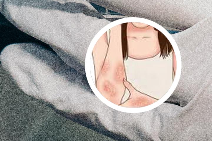 小狗身上长牛皮癣怎么治