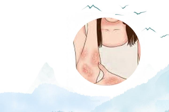 成都副银屑病医院排名