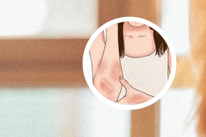 延安街牛皮癣事件