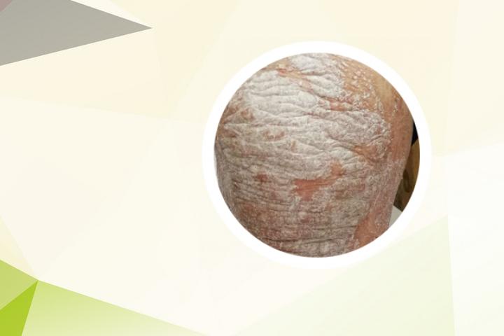 头上牛皮癣能用硫磺皂吗