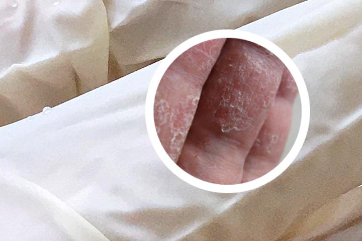 我患有银屑病，该如何进行护理呢
