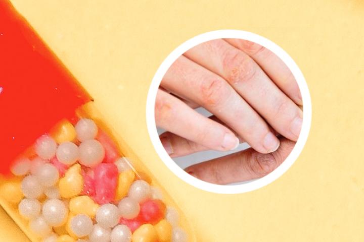 梅毒误诊牛皮癣