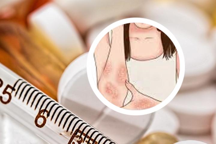 牛皮癣怎痒么