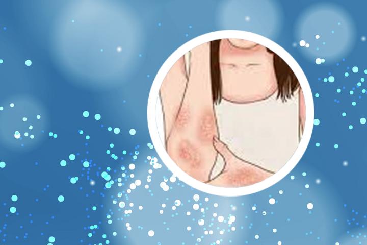 湿热银屑病图片和症状