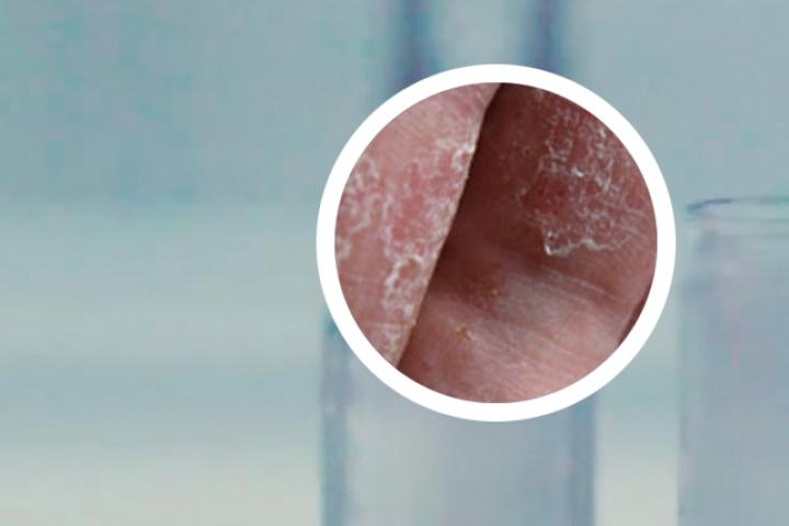用石榴水抹牛皮癣