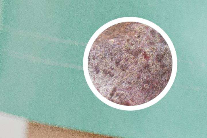 目前治牛皮癣最好的办法