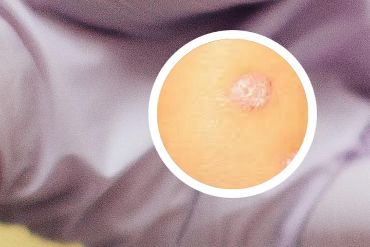 甘草片治疗牛皮癣
