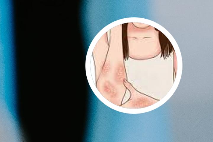 牛皮癣吃阿昔洛韦多久