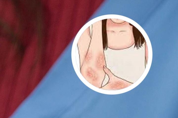 干燥性湿疹和牛皮癣
