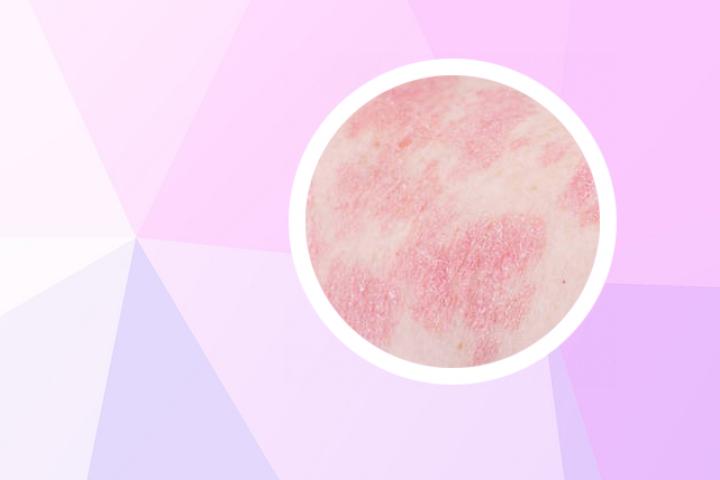桂枝汤治牛皮癣