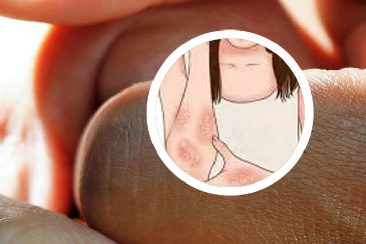罗明初银屑病