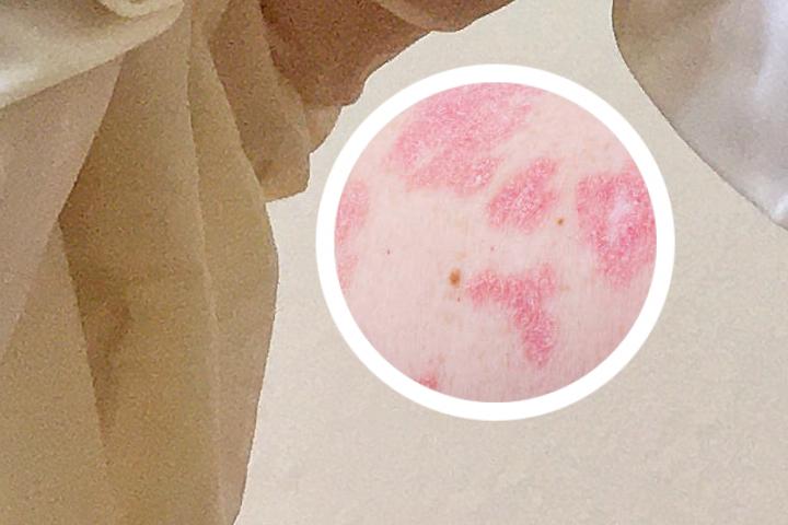 生物制剂单抗类治疗牛皮癣